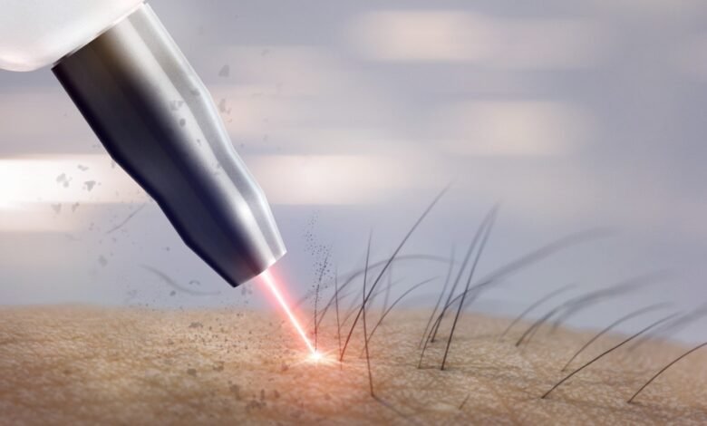 The Benefits of Laser Hair Removal for Men, Explained 1 Laser hair removal
