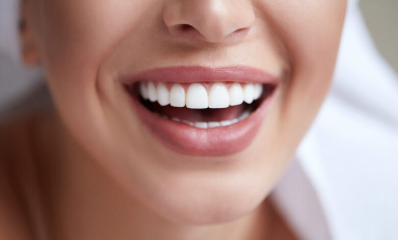 Veneers